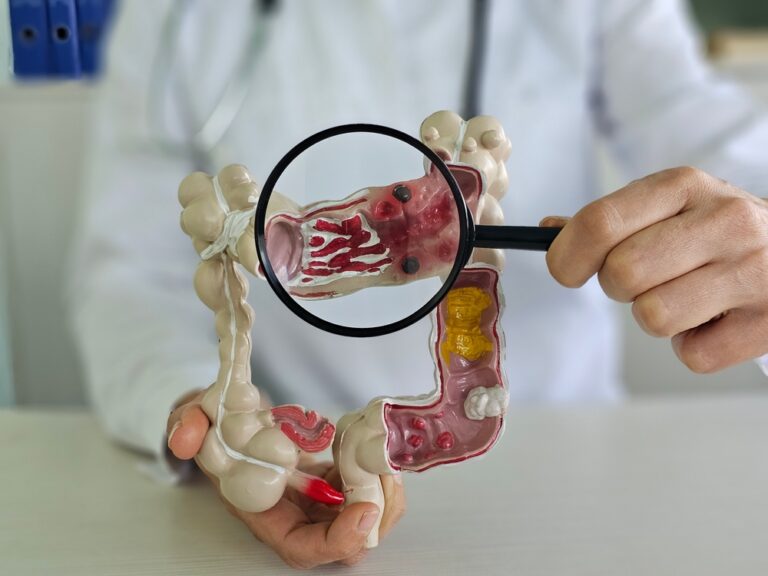 ADH-Colon-Cancer-vs.-IBD